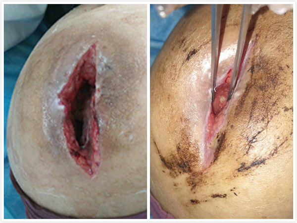 预防骨髓炎的方法