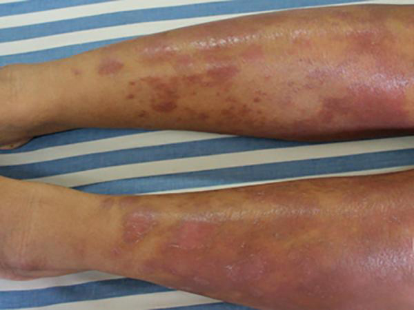 急性血源性胫骨骨髓炎