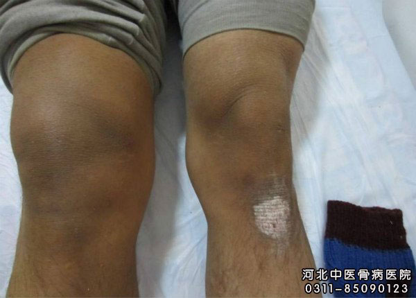 滑膜炎