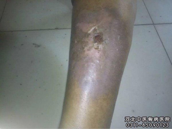 小腿慢性溃疡