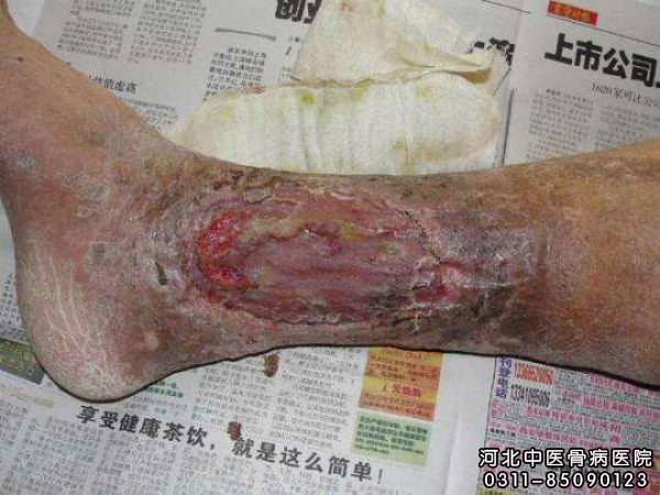 小腿慢性溃疡