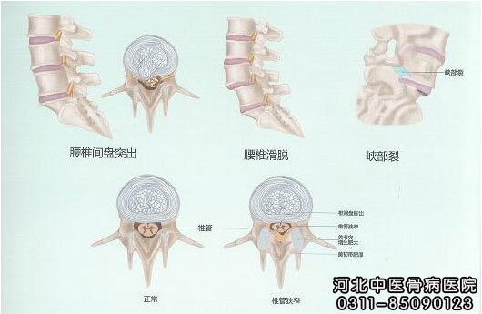 微创&椎间孔镜手术告患者书
