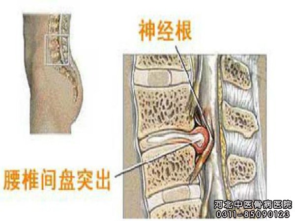 腰椎间盘突出