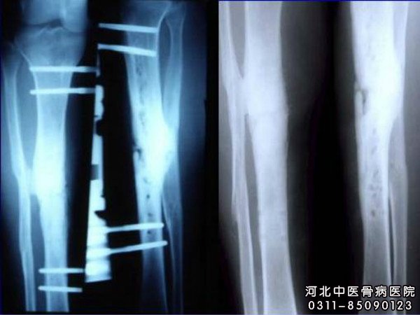骨不连