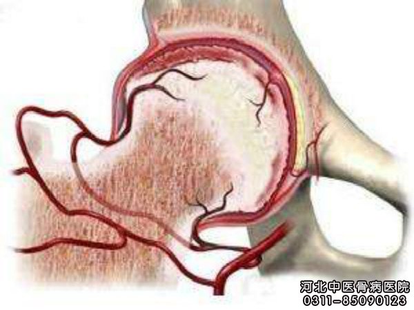 股骨头坏死示意图