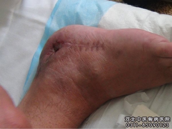 我院骨髓炎患者的伤口部位