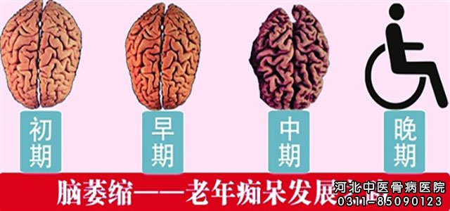 脑萎缩-老年痴呆发展之路