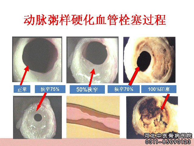 动脉粥样硬化栓塞过程