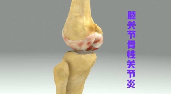 骨关节炎